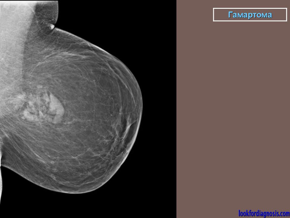 Маммография молочных желез 4. Фиброаденолипома(гамартома). Фиброаденома молочной железы маммография. Фибролипома молочной железы маммография. Гамартома маммография.