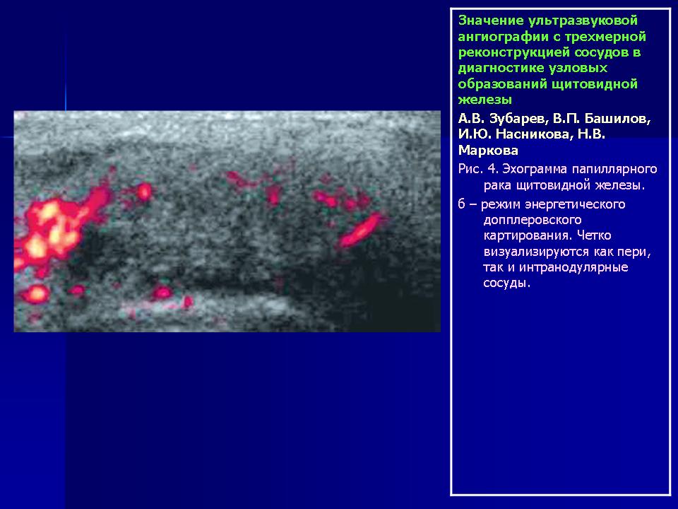 Усилен сосудистый рисунок щитовидной железы что это значит