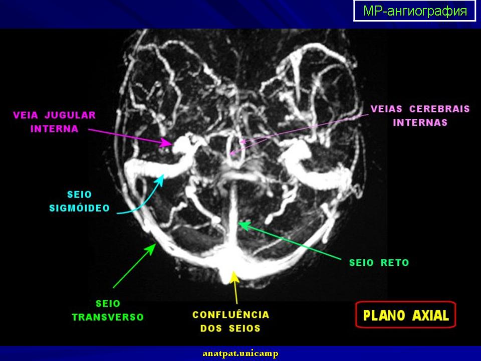 Гипоплазия правого поперечного синуса. Тромбоз поперечного синуса головного мозга на кт. Тромбоз венозного синуса головного мозга кт. Тромбоз сигмовидного синуса на кт. Тромбоз поперечного синуса мрт.