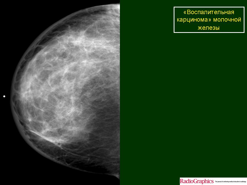 Онкология молочных желез симптомы. Фиброзно-кистозная мастопатия маммография. Рик молочной железы маммографич. Вид онкологии груди на маммографии.