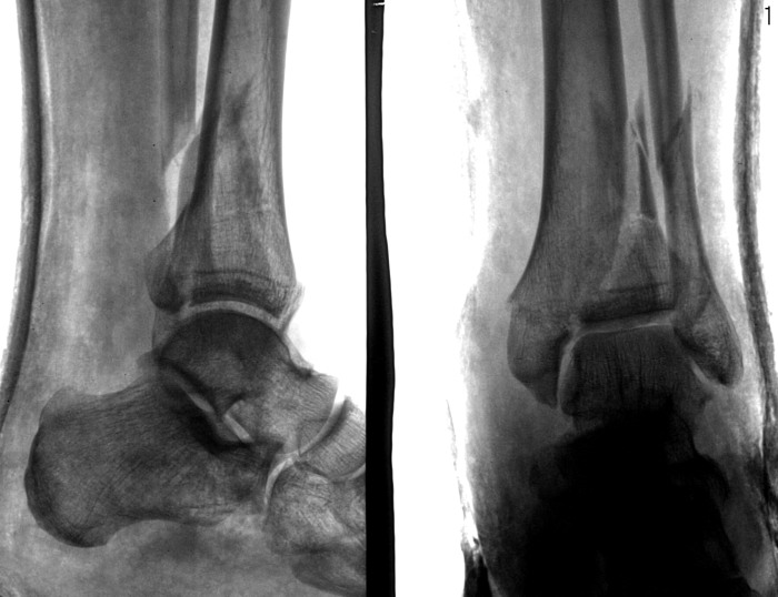 Как выглядит разрыв связок голеностопа на рентгене фото