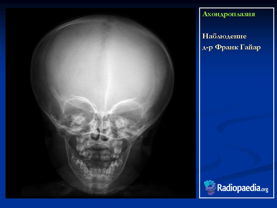 Детский череп рентген. Ахондроплазия рентген черепа. Рентгенограмма черепа новорожденного. Череп маленького ребенка рентген.