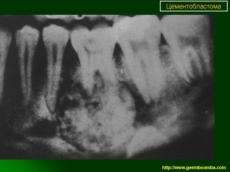 Миобластома. Цементома нижней челюсти рентген. Периапикальная цементная дисплазия кт.