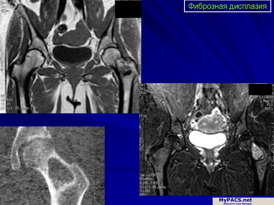 Фиброзная дисплазия