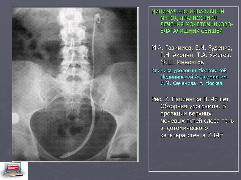 Установка стенда в мочеточник. Стент мочеточника рентген описание.
