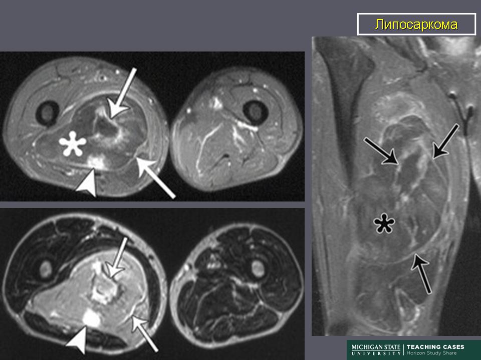 Липосаркома забрюшинного пространства фото