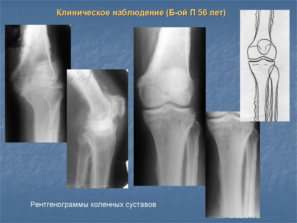 Периостит голени фото