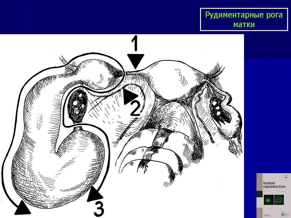 Рудиментарный. Внематочная беременность в рудиментарном Роге. Двурогая матка с рудиментарным рогом. Беременность в рудиментарном Роге матки. Беременность в рудиментарном Роге УЗИ.