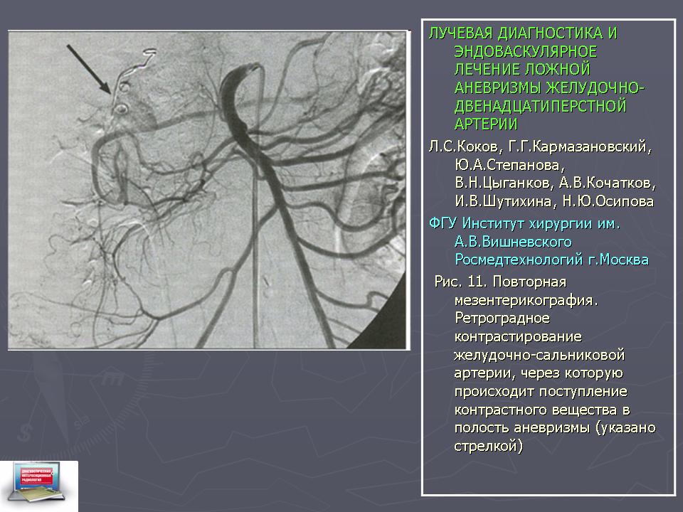 Эндоваскулярная операция головного мозга. Ангиография бедренной артерии. Контрастирование бедренной артерии. Аневризма бедренной артерии. Ложные аневризмы артериальных.