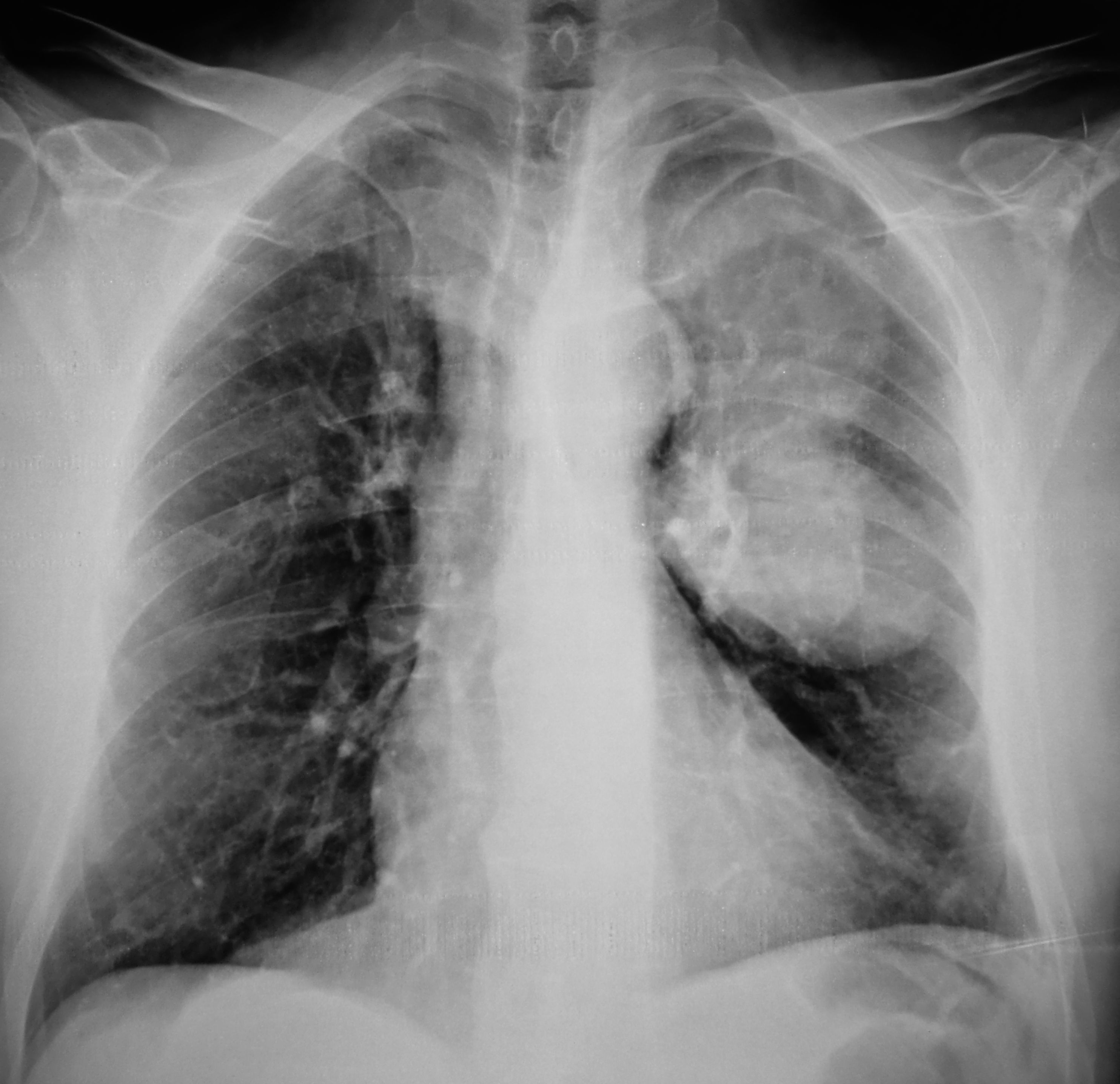 Нормальная рентгенография легких