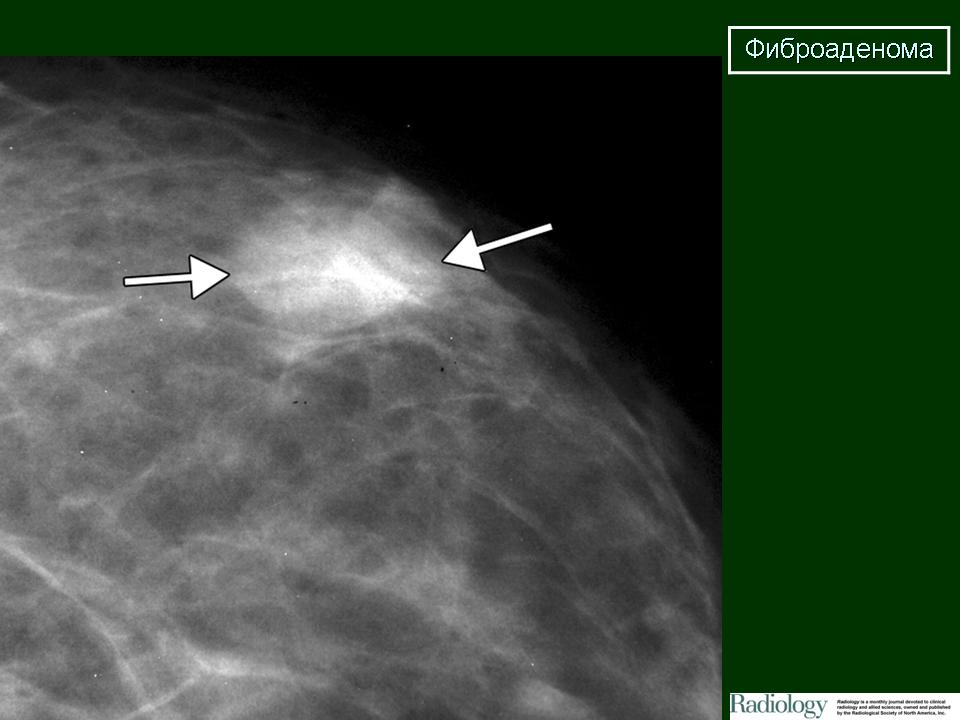 На фоне фиброзных изменений. Фиброаденома молочной железы маммограмма. Фиброаденома молочной железы маммография. Обызвествленная фиброаденома маммография. Фиброаденома молочной железы рентген.