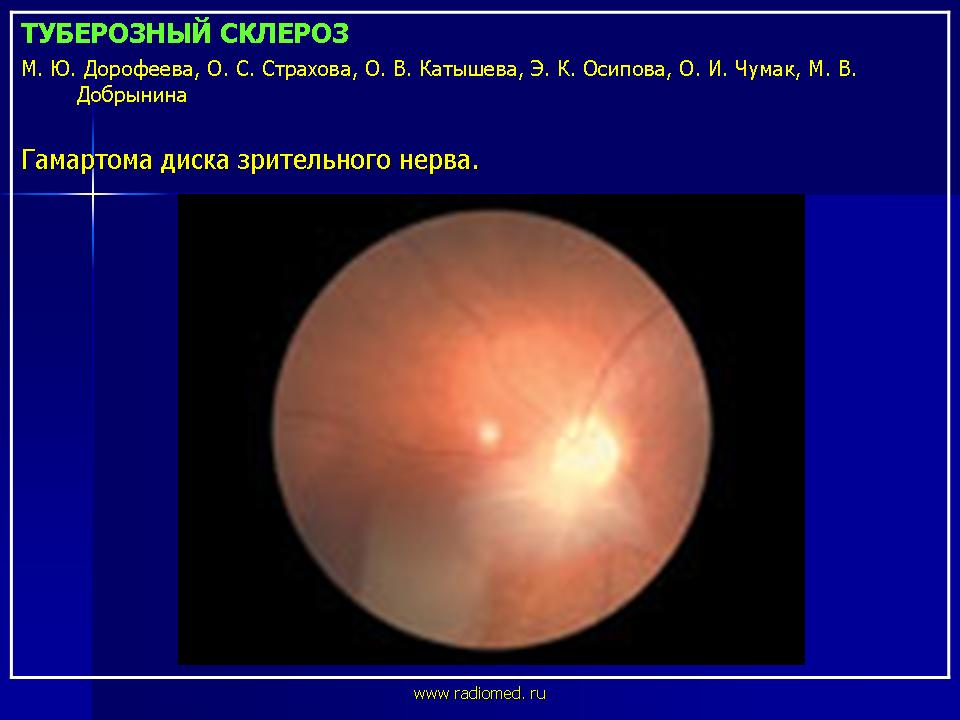 Туберозный склероз. Туберозный склероз глазное дно. Туберозный склероз пятна. Туберозный склероз кожи.