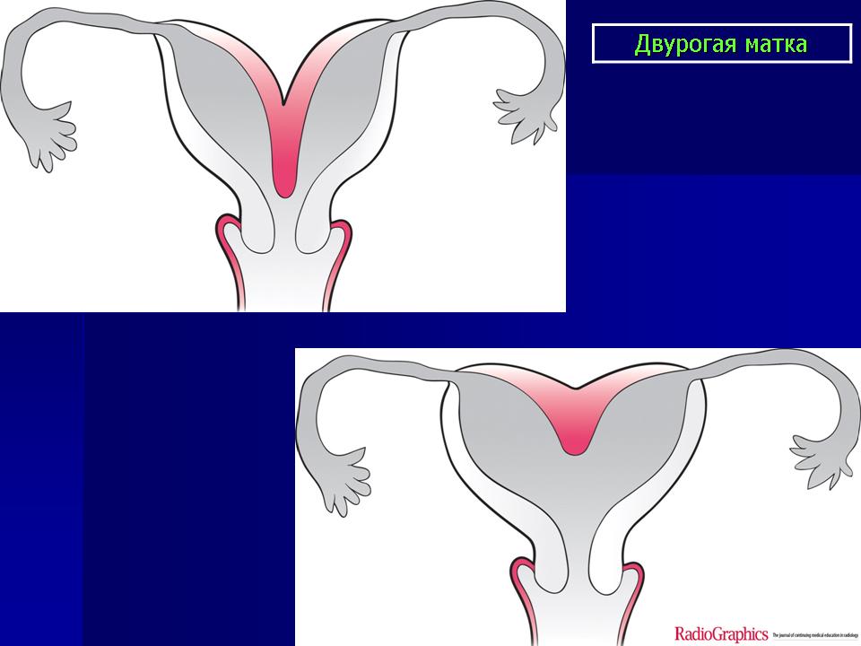 Как выглядит двурогая матка у женщины при беременности фото