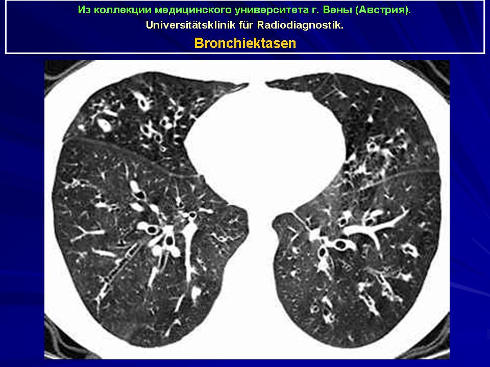 Кт картина бронхоэктазов