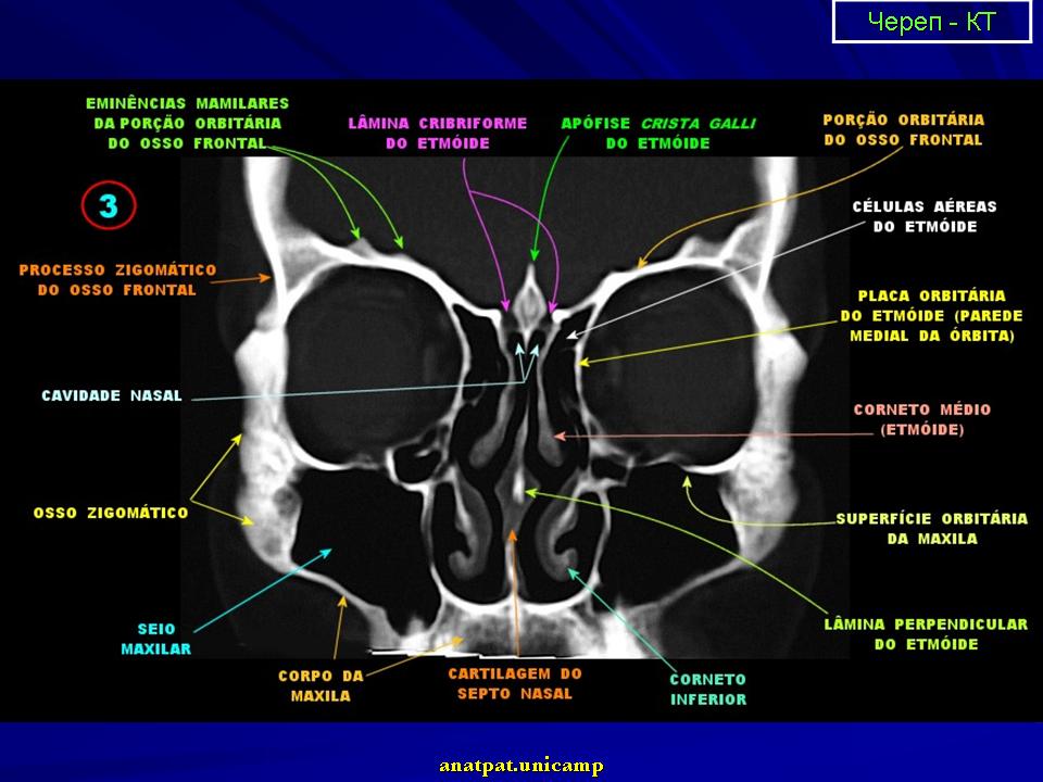 Кт анатомия. Кт анатомия костей основания черепа. Анатомия основания черепа на кт. Анатомия клиновидной кости на кт. Клиновидная кость кт анатомия.
