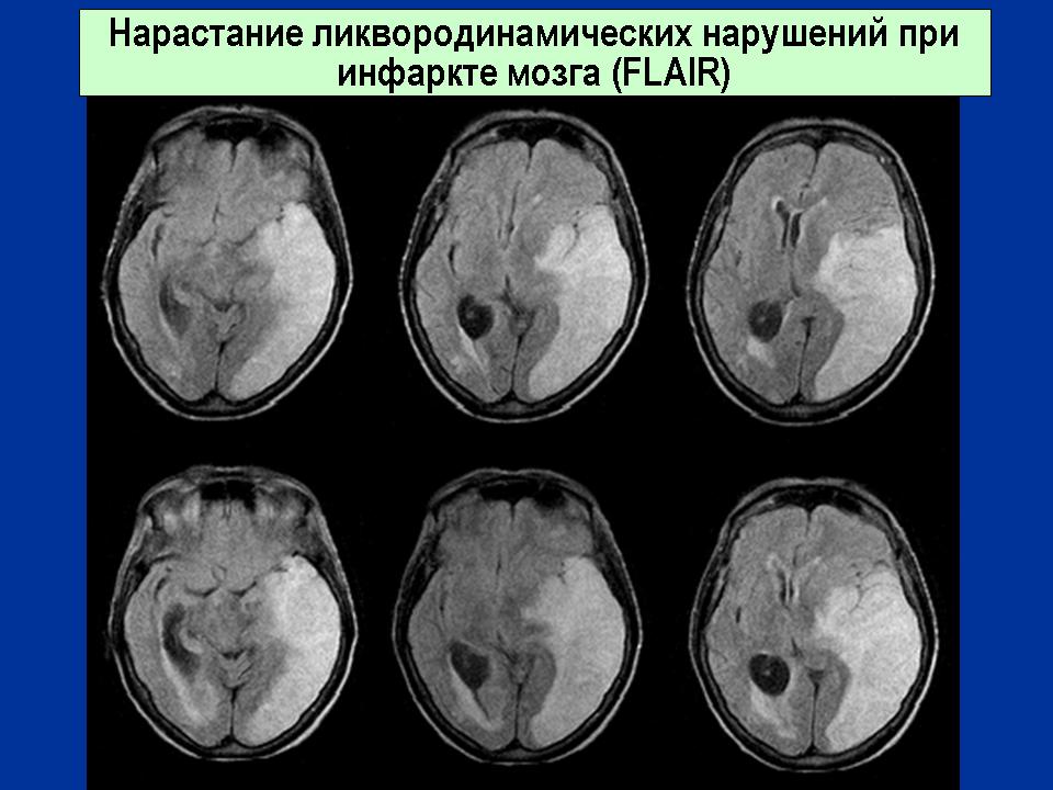 Синдром ликвородинамических нарушений. Нарушение ликвородинамики. Ликвородинамические нарушения головного мозга последствия. Ликвородинамические пробы.