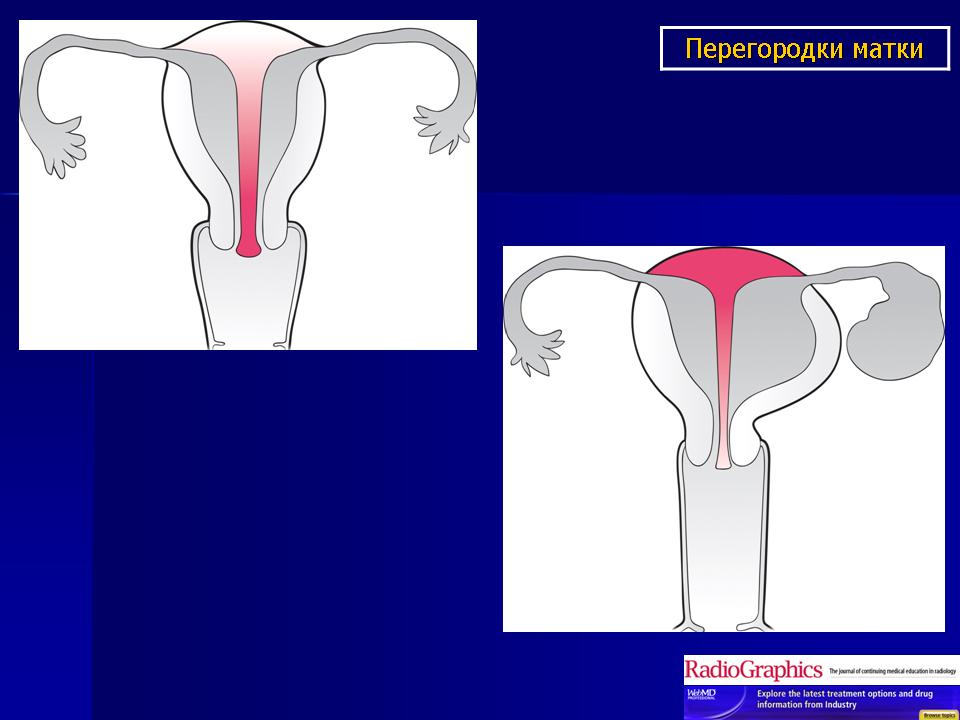 Перегородка в матке. Полная перегородка матки. Неполная перегородка матки. Перегородка внутри матки.