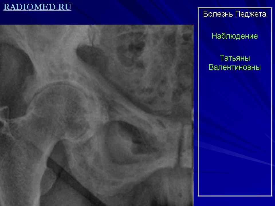 Болезнь педжета презентация