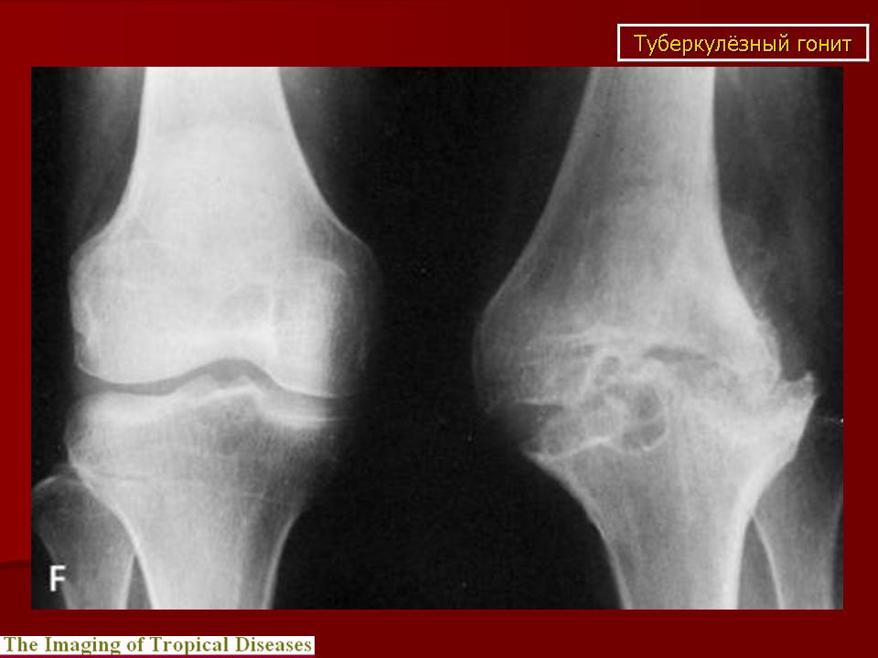 Коленный туберкулез. Туберкулез коленного сустава рентген. Рентгенограмма туберкулезного артрита.