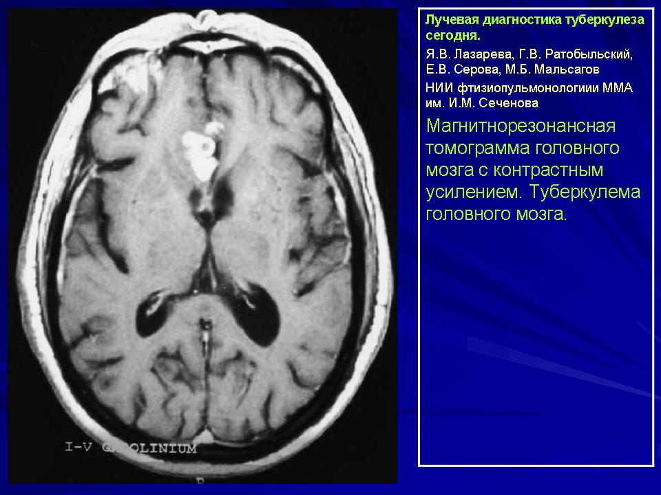Туберкулез головного. Туберкулома головного мозга компьютерная томография. Туберкулез головного мозга кт. Туберкулез мозговых оболочек кт.