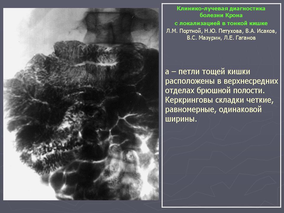 Болезнь крона как живете. Инструментальное исследование болезнь крона. Болезнь крона рентгенодиагностика. Болезнь крона тощей кишки.