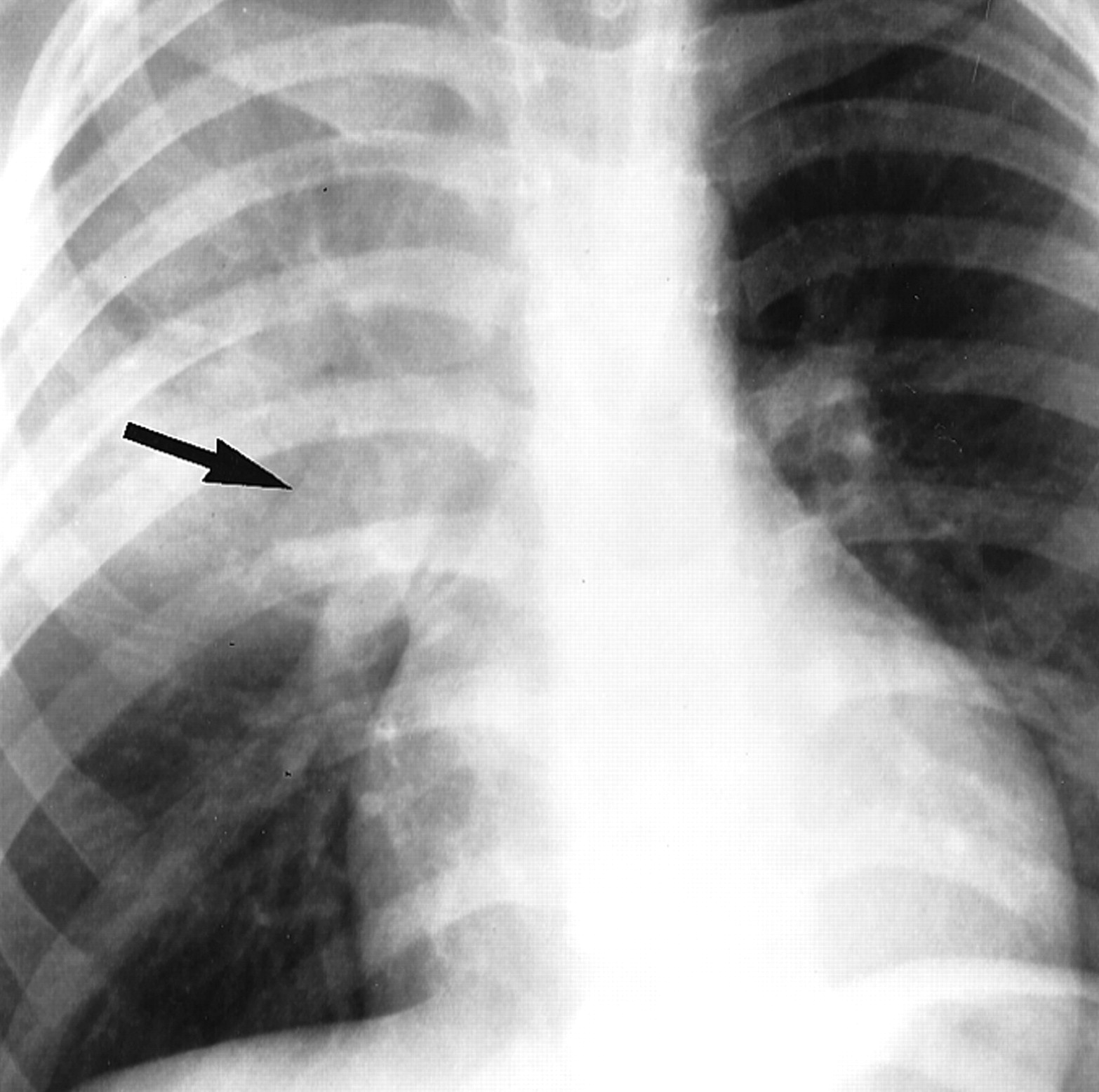 Легкие увеличен узел. Внутригрудная лимфаденопатия рентген. Лимфаденопатия средостения рентген. Туберкулез внутригрудных лимфатических узлов рентген. Туберкулез внутригрудных лимфатических узлов снимки.