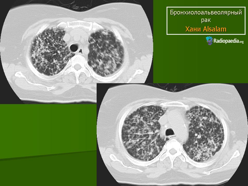 Бронхоальвеолярный рак презентация