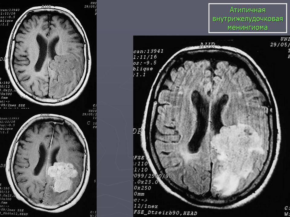 Менингиома головного мозга форум. Менингиома головного мозга кт. Менингиома основания лобной доли. Фалькс менингиома кт.
