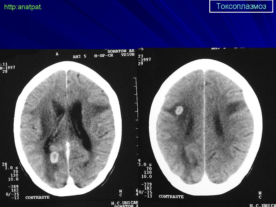 Токсоплазмоз головного мозга кт картина