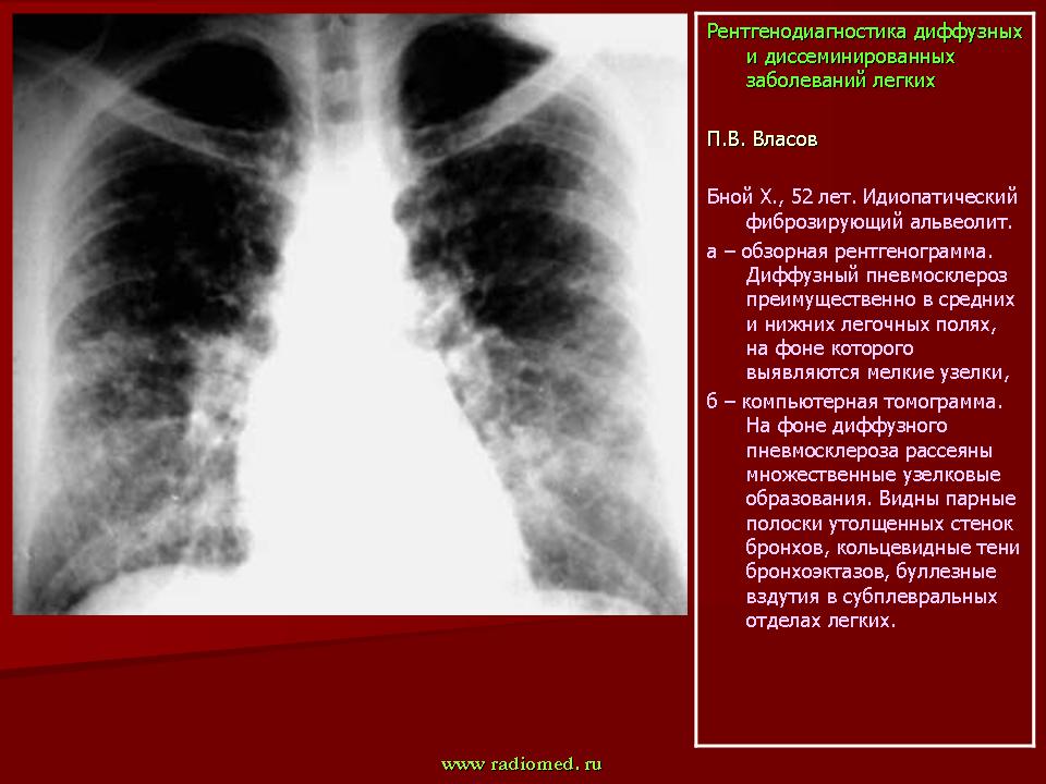 Картина фиброзных изменений. Интерстициальные заболевания легких рентген. Интерстециальныезабоевания лёгки рентген. Синдром интерстициального поражения легких. Диффузный пневмофиброз рентген.