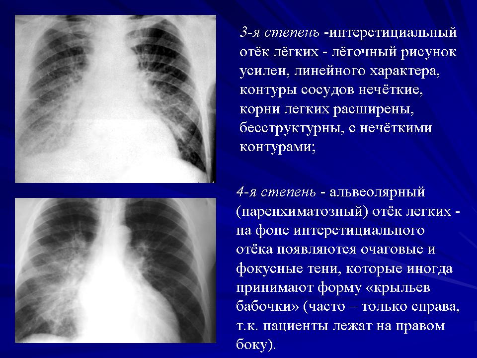 Отечность легких