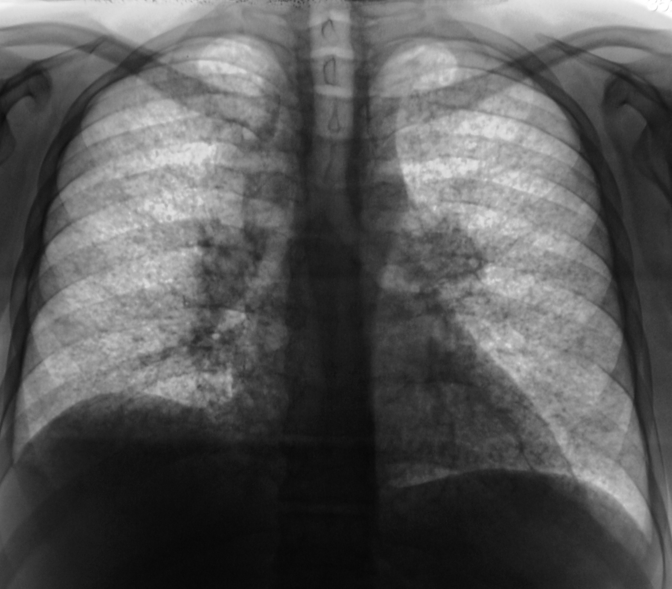Милиарный диссеминированный туберкулез рентген