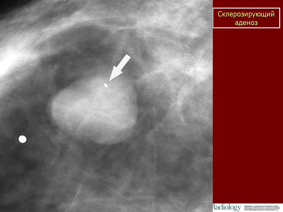 Тяжистый фиброз молочной железы на маммографии фото