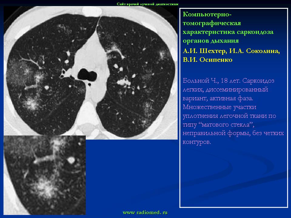 Кт картина саркоидоза легких