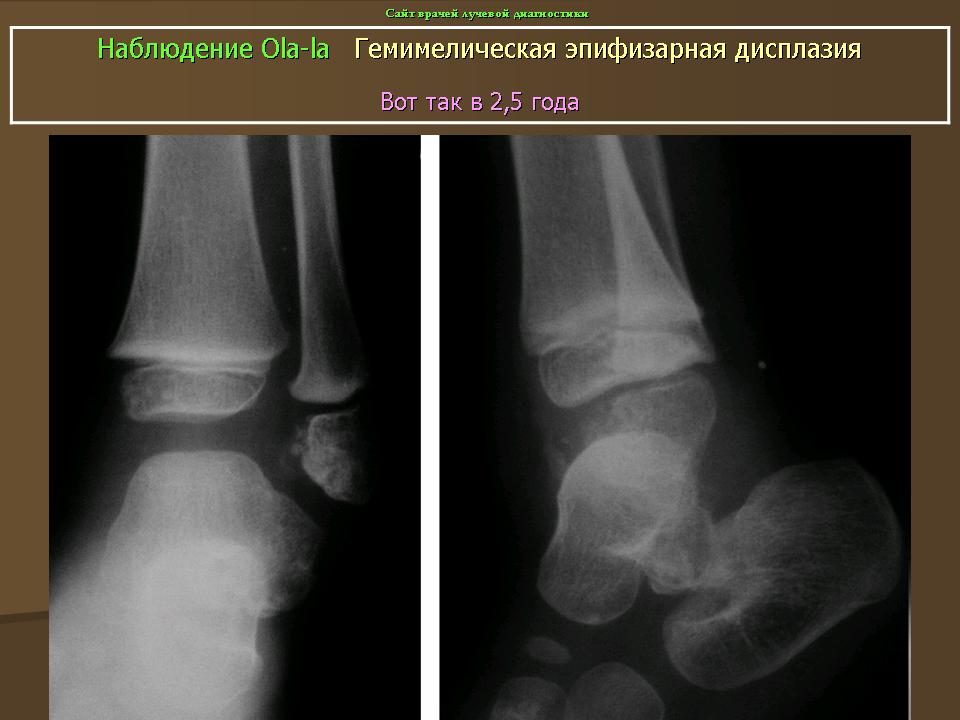 Эпифизарная дисплазия голеней рентген. Экзостозная дисплазия. Эпифизарная дисплазия тазобедренного сустава. Экзостозная костно-хрящевая дисплазия.