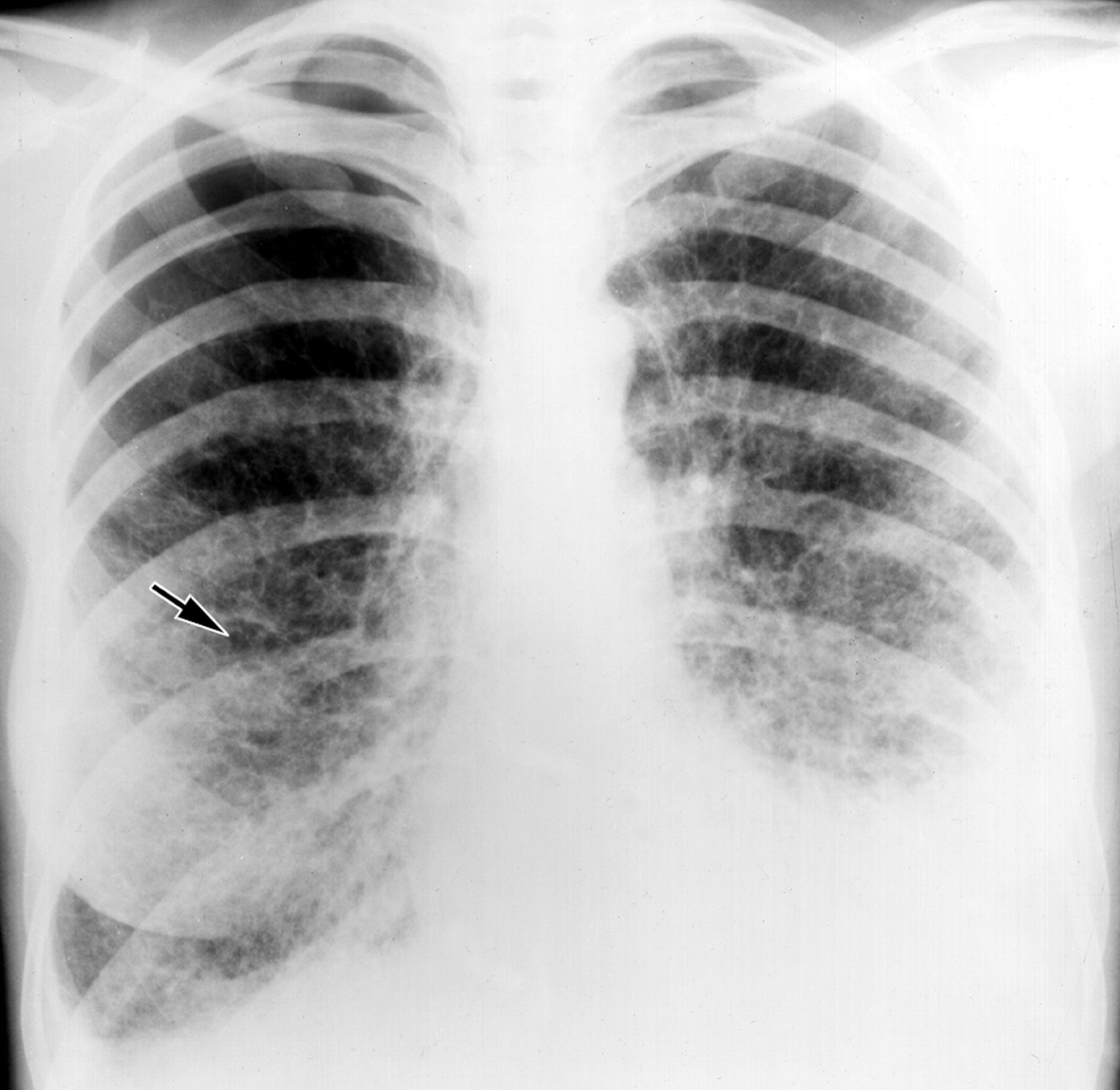 Умеренные фиброзные изменения. Посттуберкулёзный пневмосклероз. Пневмофиброз пневмосклероз пневмофиброз. Диффузный пневмосклероз рентген. Пневмофиброз легких рентген.