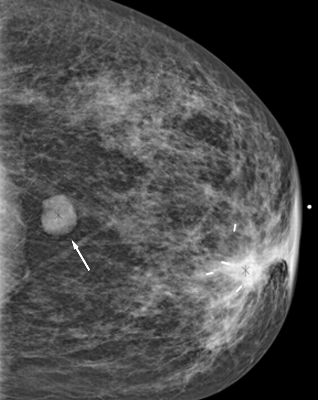 Фиброма в груди. Фиброаденома молочной железы маммограмма. Липома молочной железы маммография УЗИ. Маммография фиброаденома. Липома молочной железы маммограмма.