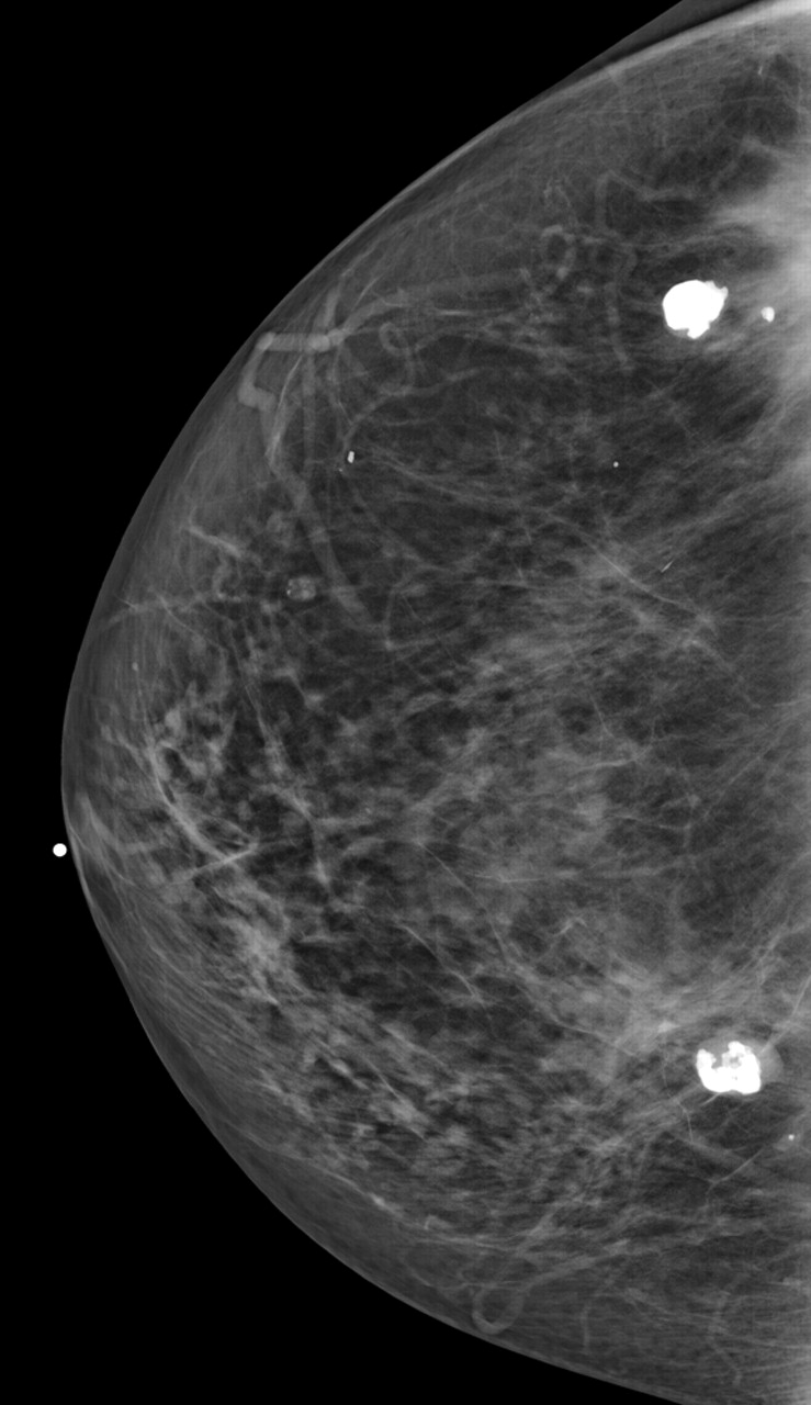 Диффузный фиброаденоматоз молочных желез что это такое. Фибролипома маммография. Фиброаденома молочной железы маммограмма. Диффузный фиброаденоз. Фибролипома молочной железы рентген.