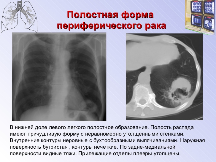 Лучевая диагностика рака легкого презентация