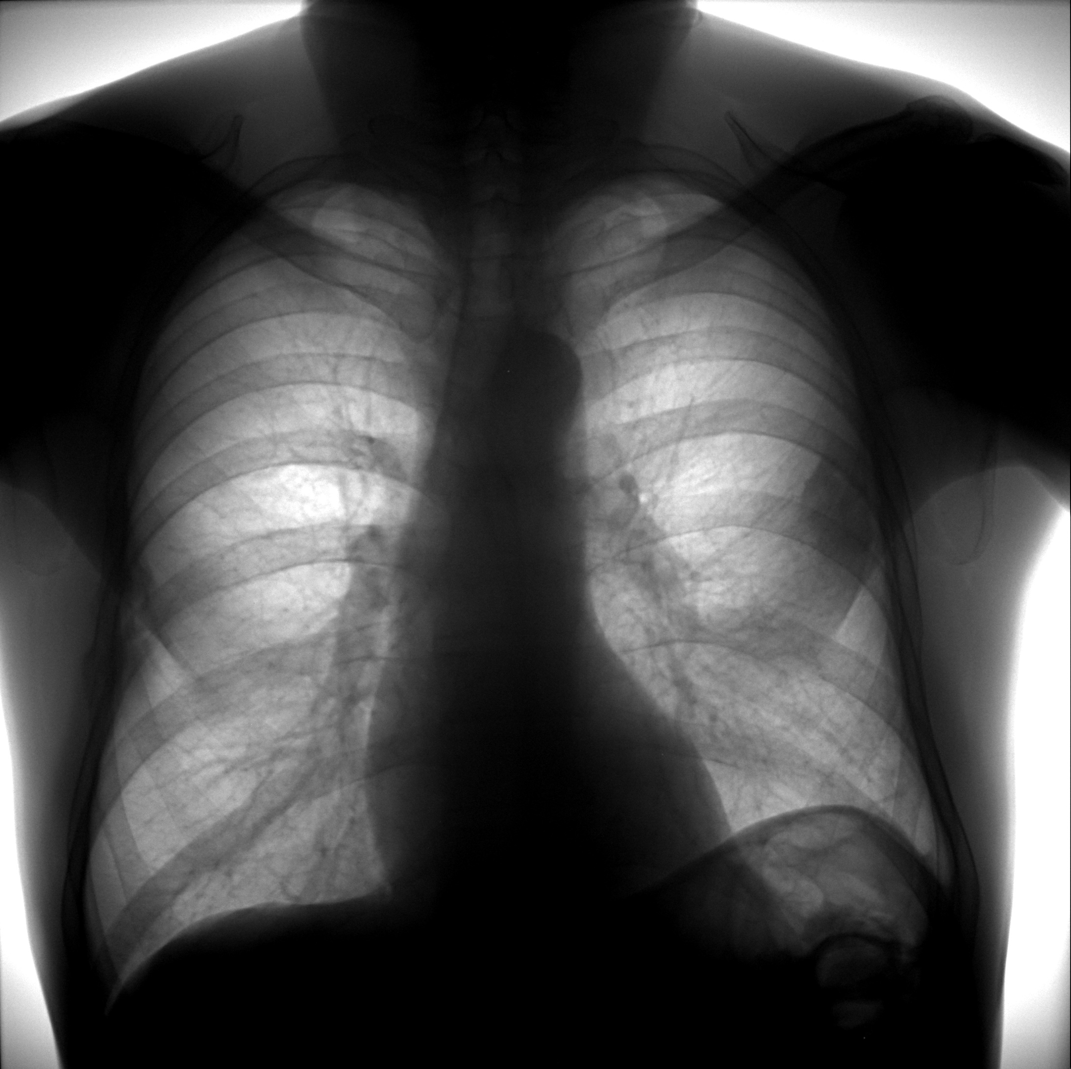 Флюорография легких. Флюорограмма пневмония. Нижнедолевая пневмония справа рентген. Флюорография легких пневмония.