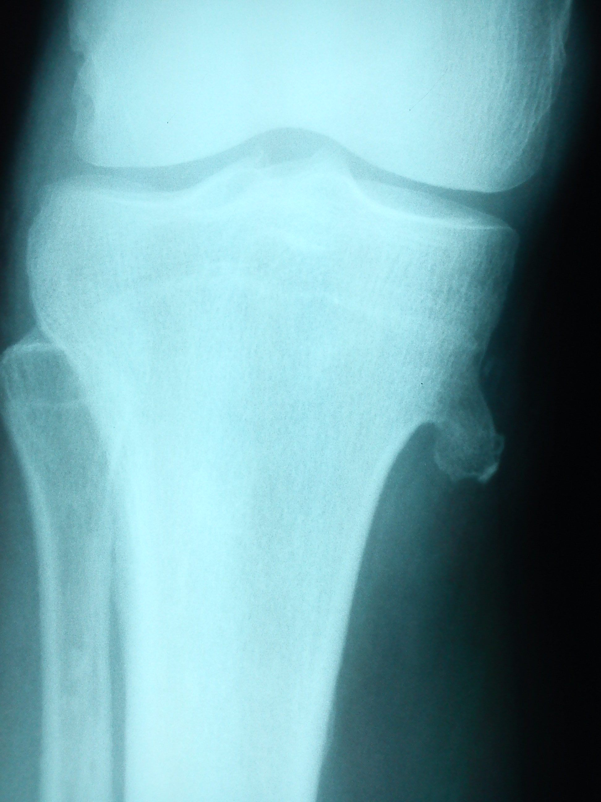 Костный нарост. Экзостоз коленного сустава рентген. Экзостоз большеберцовой кости рентген. Экзостоз бедренной кости на рентгене.