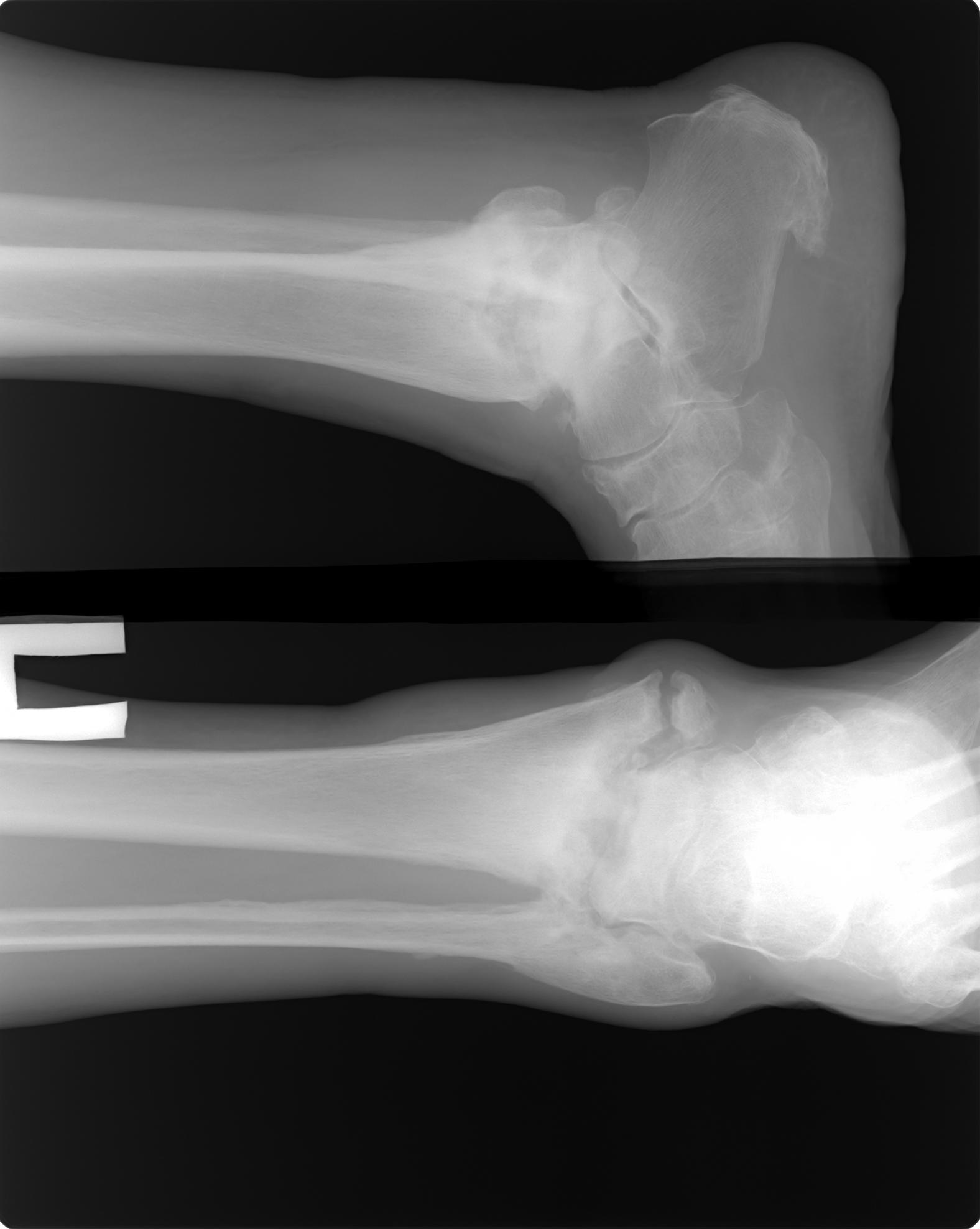 Сколько по времени заживает перелом. Остеомиелит лодыжки рентген. Остеомиелит кости на голеностопный сустав. Остеомиелит костей стопы рентген. Остеомиелит голеностопа рентген.
