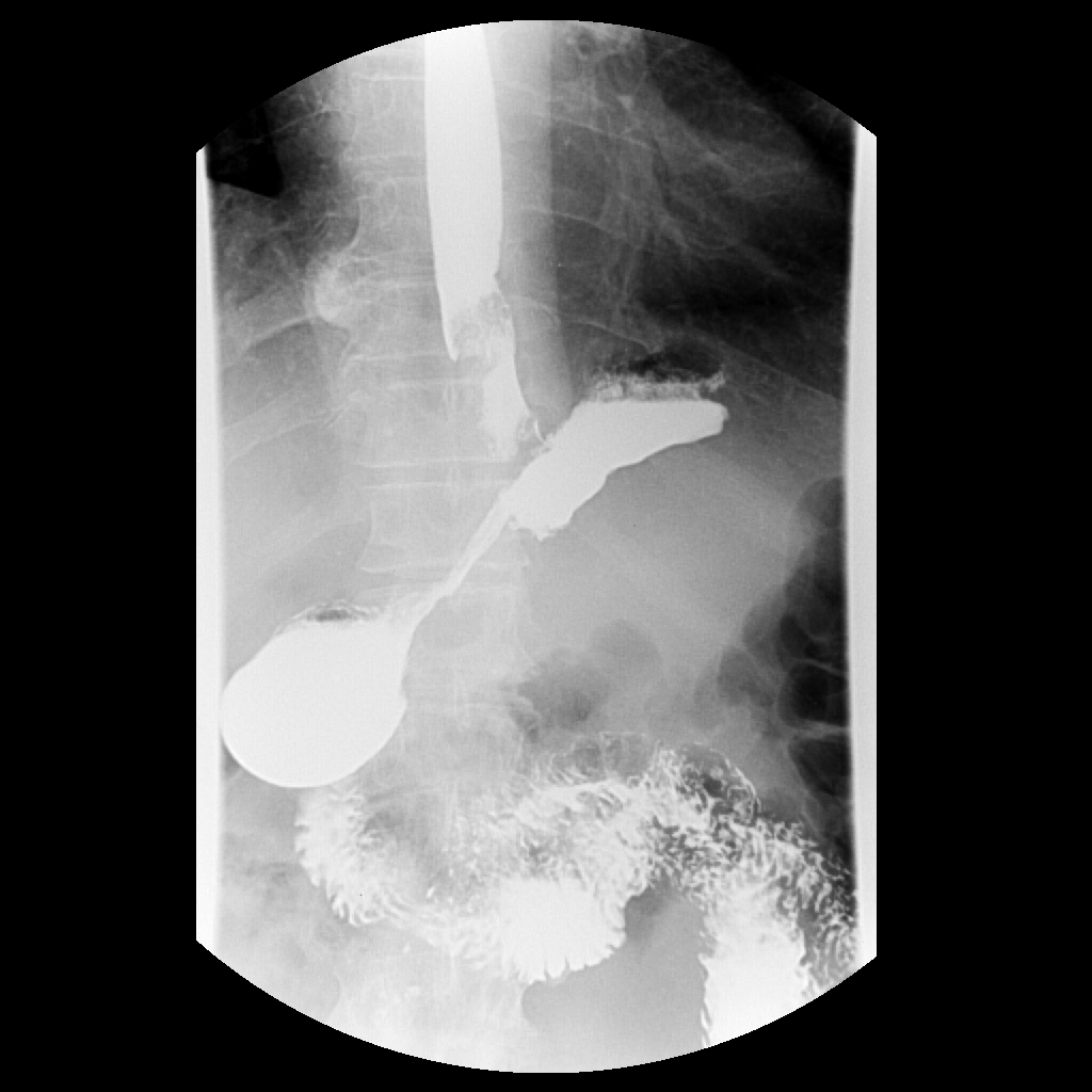 Грыжа пищевода на рентгене с барием фото