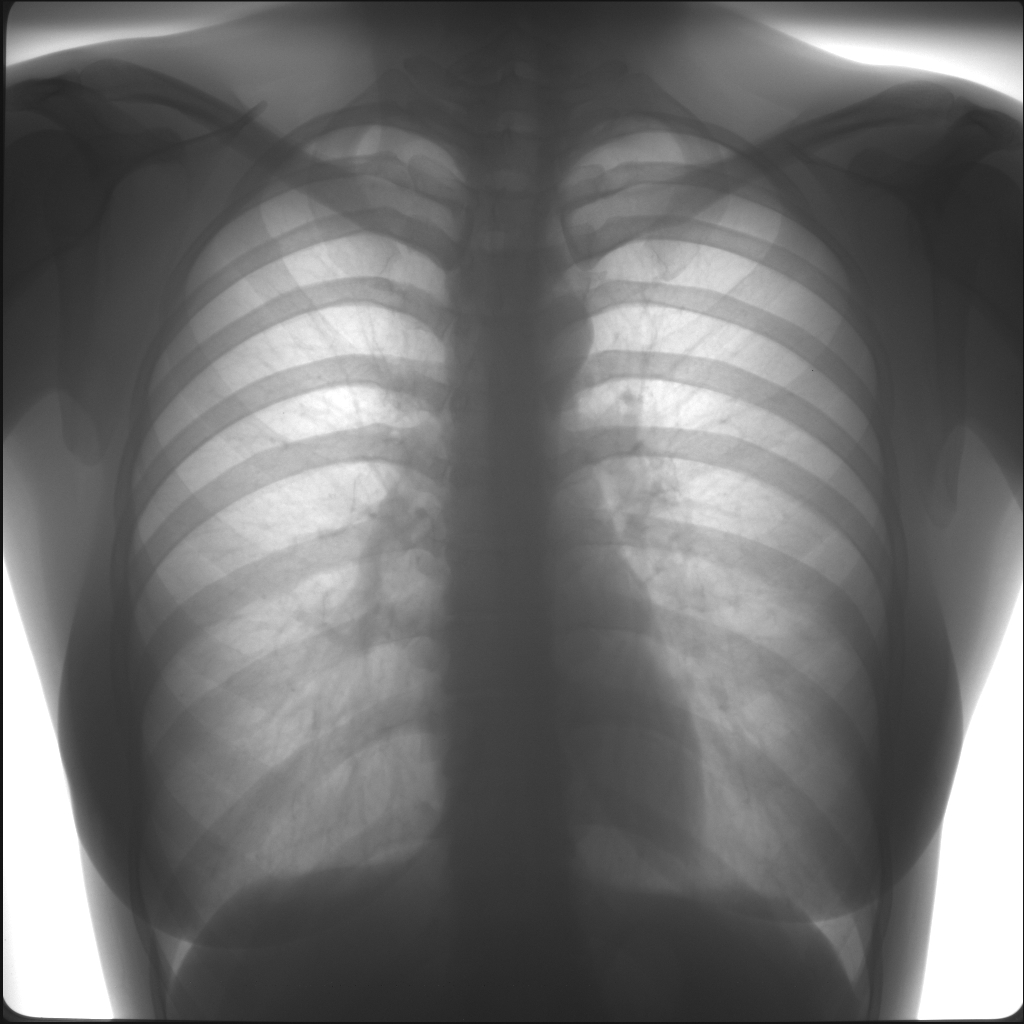 Фото здоровых легких на рентгене