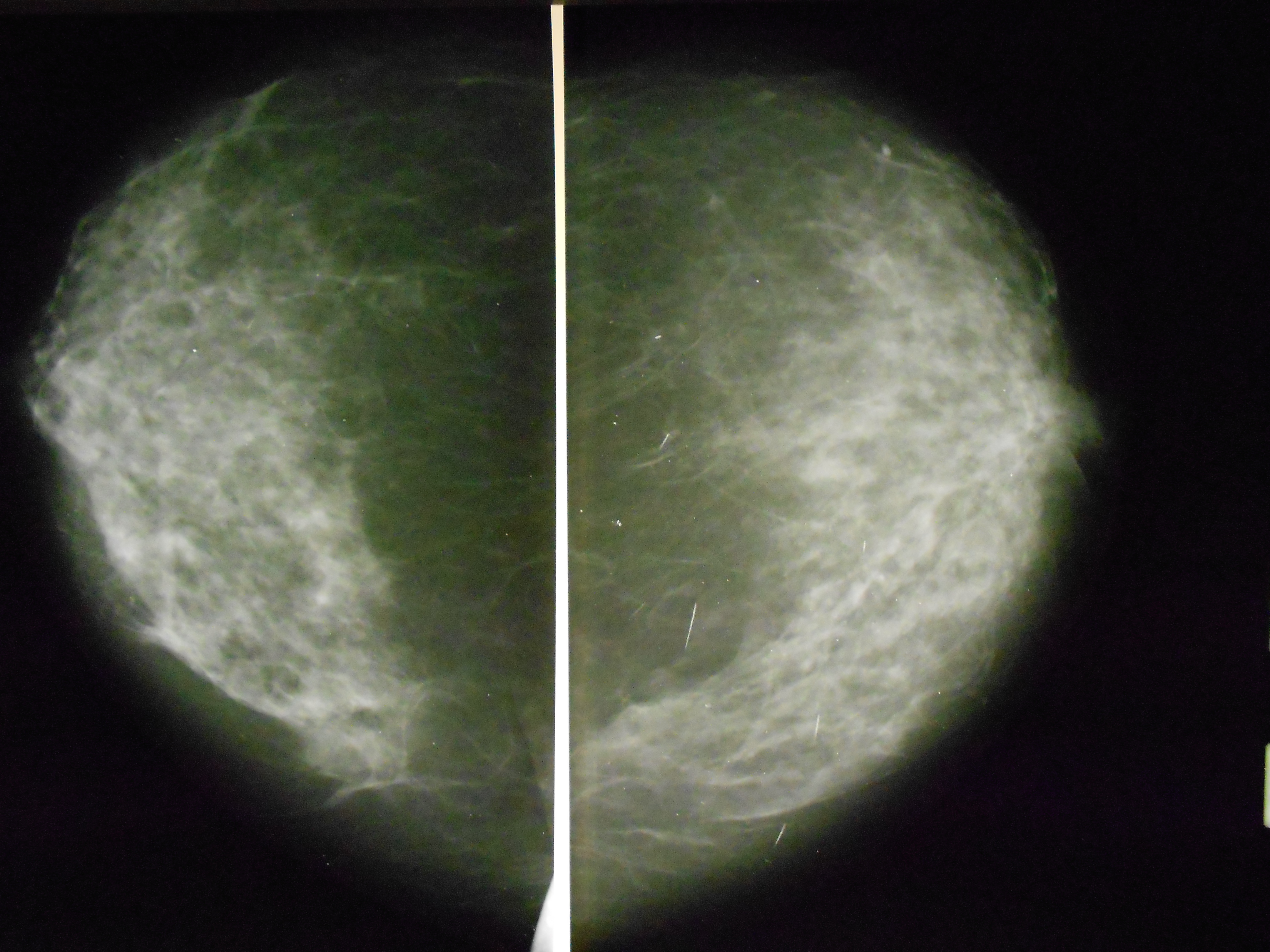 Как выглядит опухоль молочной железы на маммографии фото злокачественная