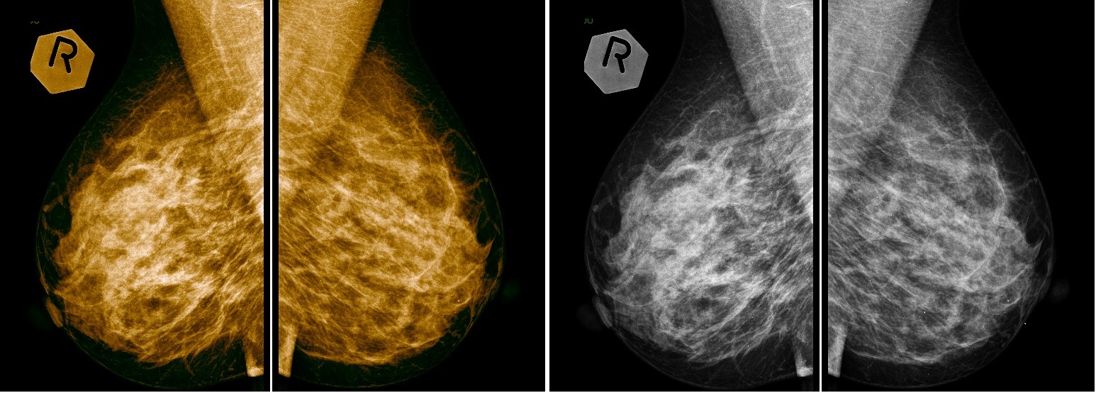 Как часто делают маммографию после 60. Маммография. Маммограмма молочных желез. Маммография укладки. Укладка груди на маммографии.