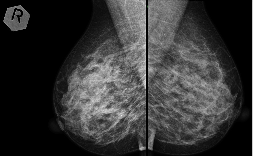 Маммография оренбург. Томосинтез снимок маммография. Прицельные рентгенограммы молочных желез. Прицельный снимок маммографии.