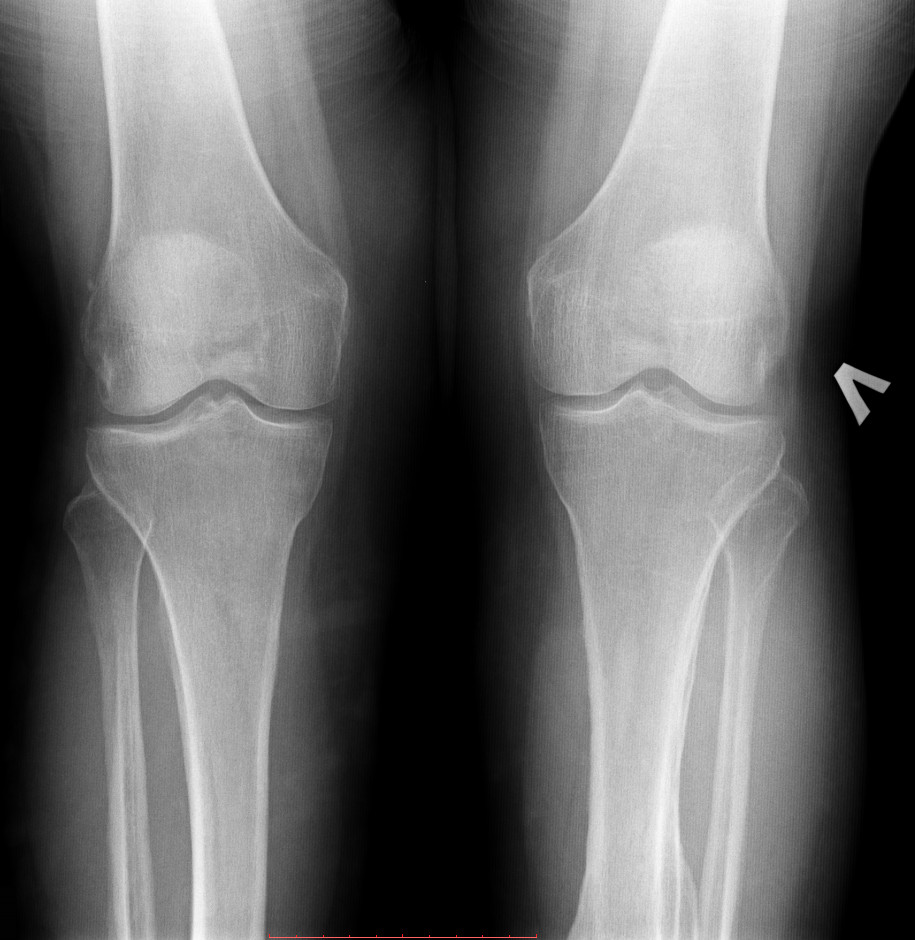 Артроз коленного сустава мениск. Менископатия коленного сустава рентген. Перелом мениска рентген. Повреждение мениска на рентгене.