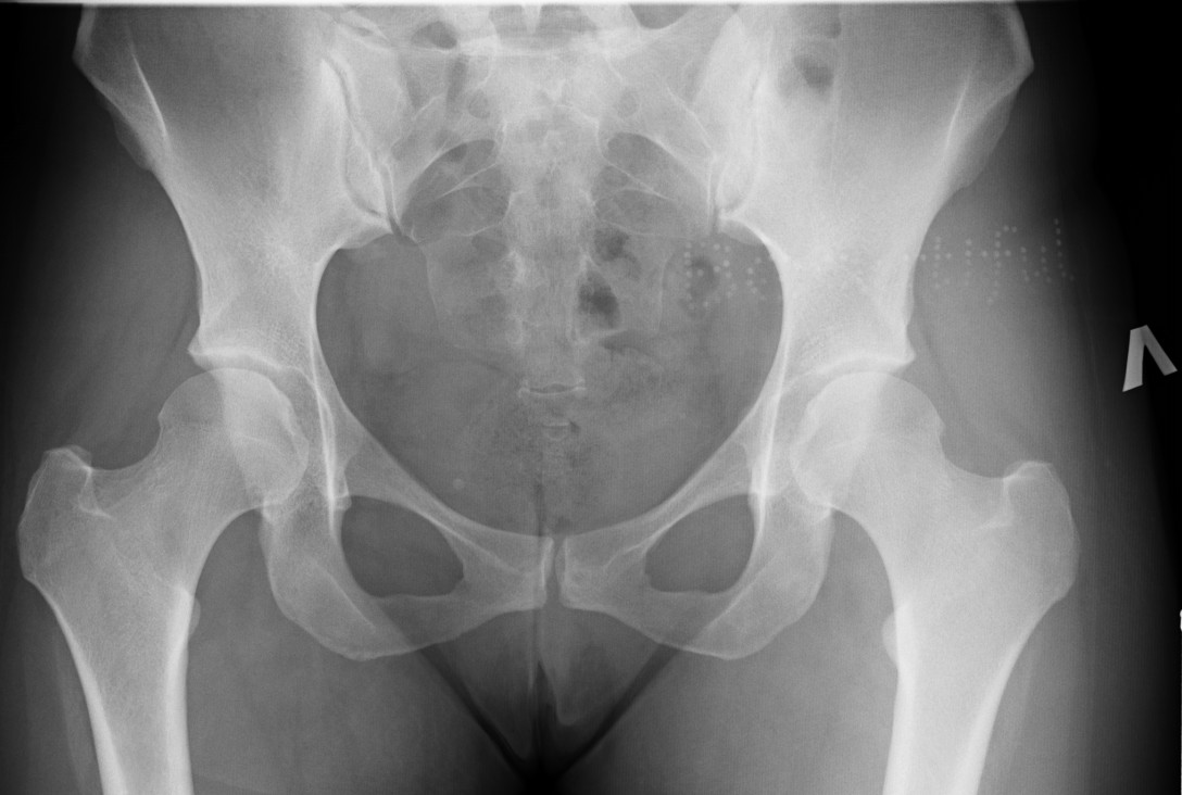 Трещина крестца. Саблевидная лобковая кость рентген. Перелом подвздошной кости таза рентген. Перелом крестца рентген. Перелом костей таза рентген.