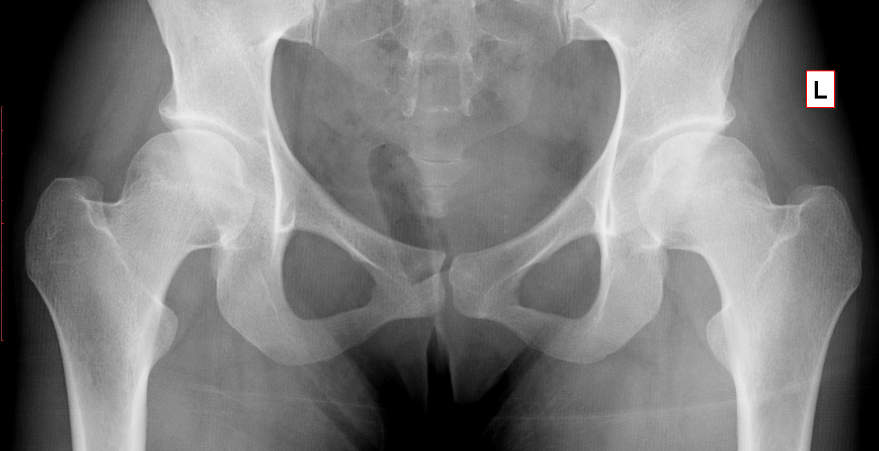 Известковый бурсит тазобедренного сустава рентген